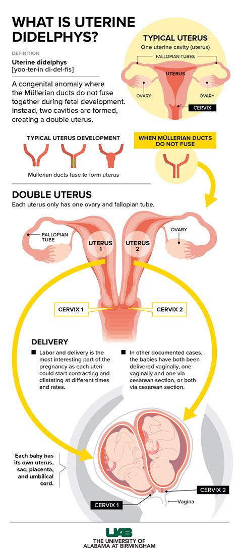 Anatomická schéma uterus didelphys s dvoma samostatnými maternicami