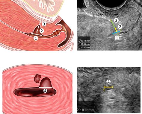 Diagram of uterine scar healing