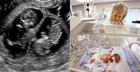 žena, ktorá si veľmi želá bábätko, a falošné tehotenstvo
