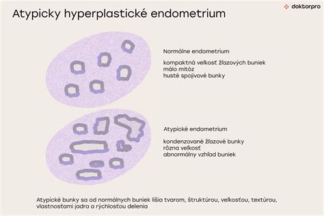 Typy hyperplázie endometria (diagram)