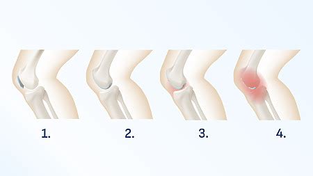 Diagram zdravého kolenného kĺbu vs. kolenného kĺbu postihnutého artrózou