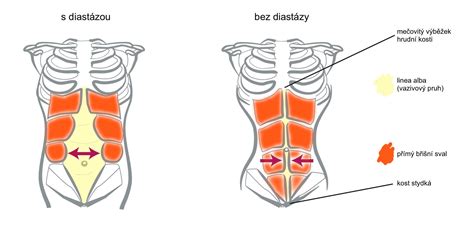 Diastáza rektí abdominis ilustrácia