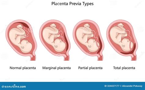 Placenta previa diagram