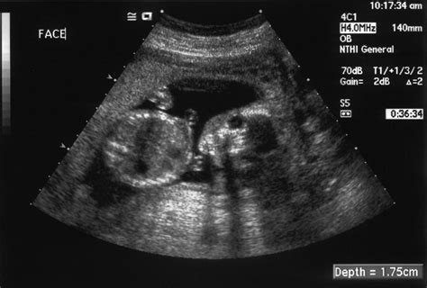 Ultrazvuk maternice s uhniezdeným embryom