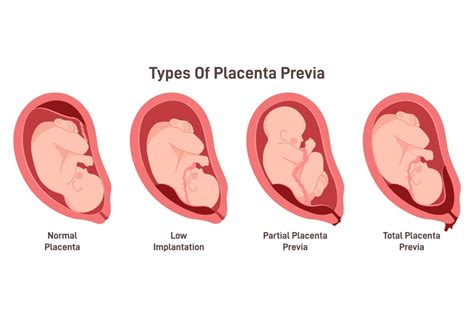 Placenta previa a abrupcia placenty ilustrácia
