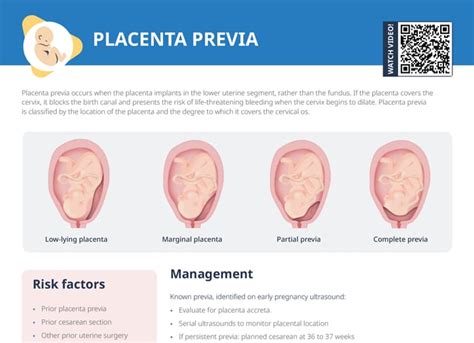 Porovnanie zdravej placenty a placenty previa