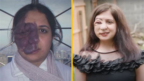 Žena a jej sebavedomie po hysterektómii