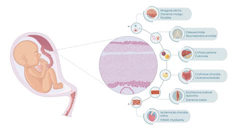 Infografika o bunkových terapiách z placenty a pupočníka