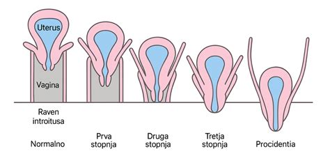 Diagram znázorňujúci normálnu polohu maternice (anteverzia) a retrovertovanú polohu (retroverzia)