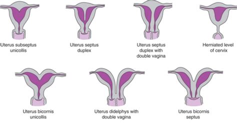 Zobrazenie dvojrohej maternice (uterus bicornis)