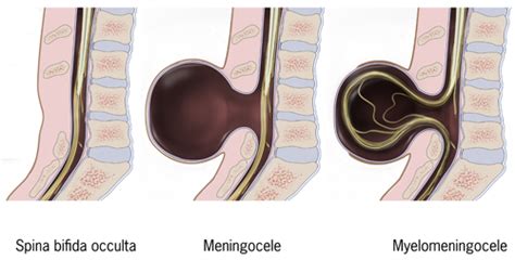 Diagram typov Spina Bifida: Occulta, Meningokéla, Myelomeningokéla