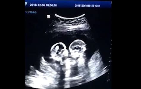 Galéria - Baby Ultrasound Identical Twins