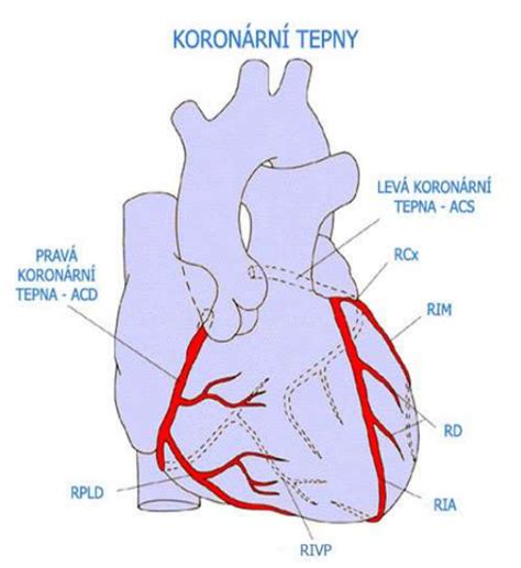 Diagram srdca a vencovitých tepien s aterosklerotickým plátom