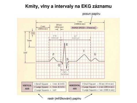 schéma EKG záznamu srdca