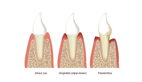 Zmeny ďasien v tehotenstve: zdravé ďasná vs. tehotenská gingivitída