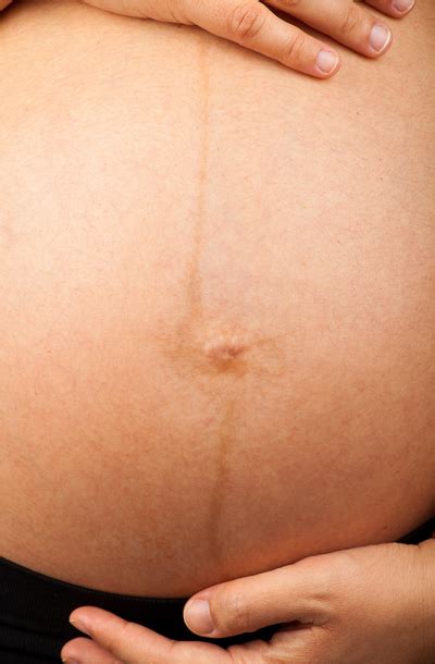 Linea nigra