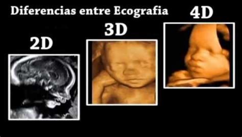 Porovnanie 2D, 3D a 4D ultrazvukových snímok plodu