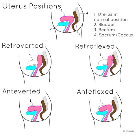 Diagram rôznych polôh maternice (anteverzia, retroverzia, retroflexia)