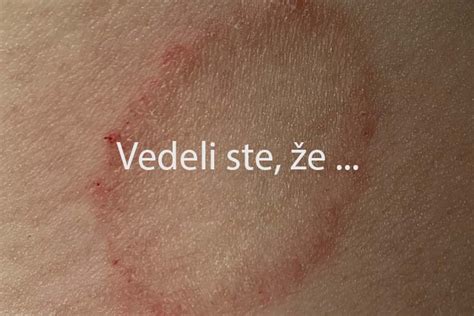 Detailné prejavy žihľavky na koži