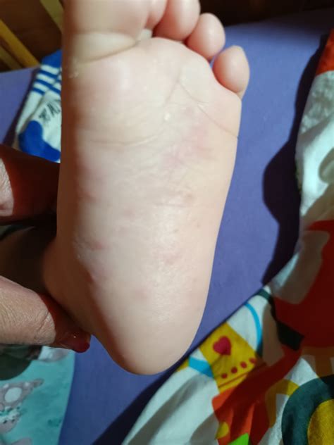 Ilustrácia dieťaťa s vyrážkami z kiahn