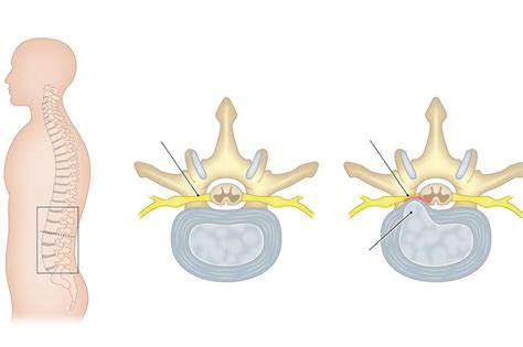 Porovnanie spinálnej a epidurálnej anestézie