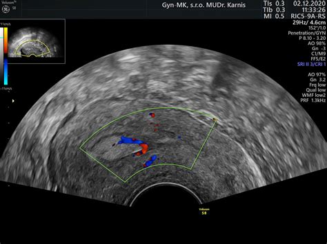 Porovnanie ultrazvukového a MRI obrazu maternice