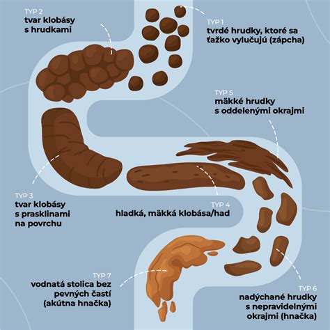 Schéma: Rozpoznanie hnačky vs. bežnej riedkej stolice