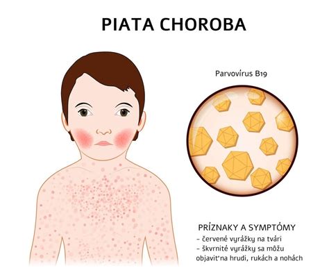 Piata choroba vyrážka na lícach