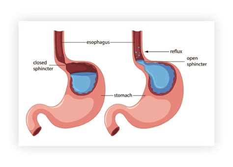 Mechanizmus vzniku gastroezofágového refluxu