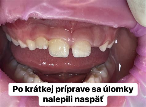 Rast čeľustí a zubov ovplyvnený cmúľaním palca