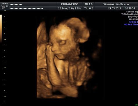 Ultrazvukové zobrazenie tváre bábätka