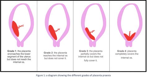 Placenta praevia