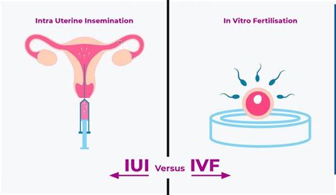 Diagram porovnávajúci intrauterinnú insemináciu (IUI) a in vitro fertilizáciu (IVF)