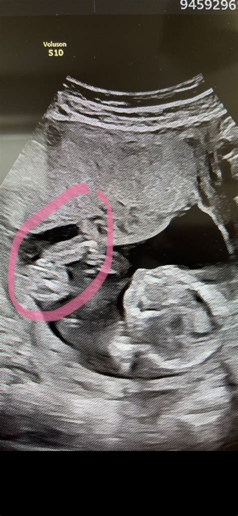 Základné rozdiely medzi chlapcom a dievčaťom na ultrazvuku