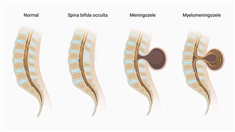 Schéma vývoja neurálnej trubice a vzniku spina bifida