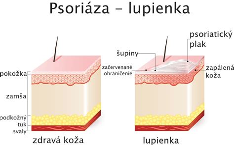 porovnanie zdravej pokožky prsníka a príznaku pomarančovej kože