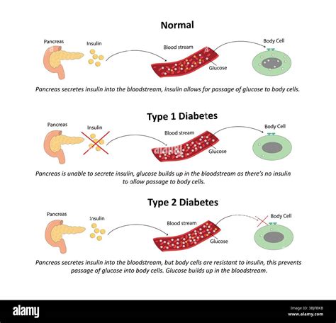 Zobrazene grafu typov diabetes mellitus a ich mechanizmov