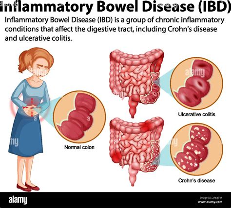 Dojčenie a IBD