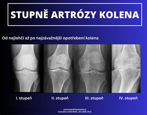 Röntgenový snímok kolena s viditeľnými známkami artrózy