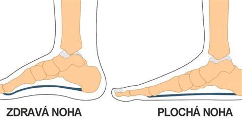 Deformity chodidla spôsobené nevhodnou obuvou