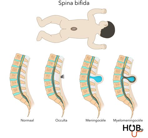 Schéma rázštepu chrbtice (spina bifida)