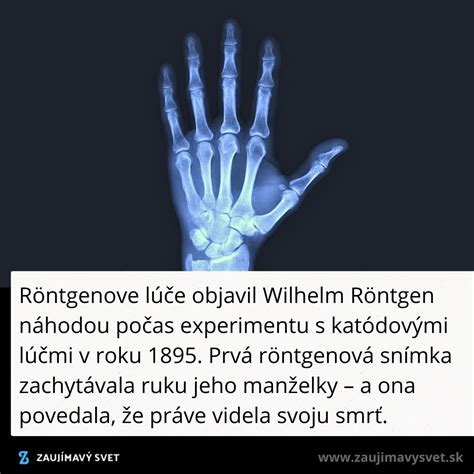 Röntgenová snímka s prehltnutým predmetom