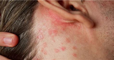Dieťa so svrbiacou vyrážkou spôsobenou atopickou dermatitídou