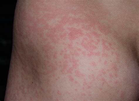 Červené fľaky alebo vyrážky u bábätka - príznaky alergie