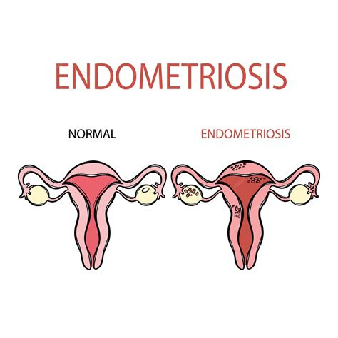 Schéma hyperplázie endometria