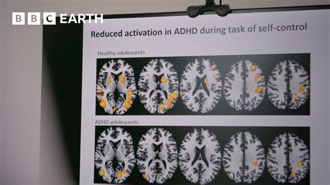 Mozog s ADHD