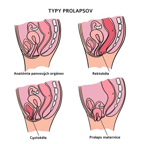 Infografika znázorňujúca rôzne typy vrodených chýb maternice