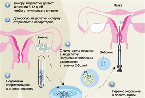 Schéma inseminácie s darcovskými spermiami