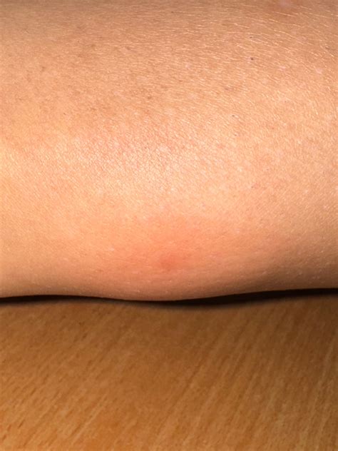 Detailný záber na detskú pokožku s miernym začervenaním