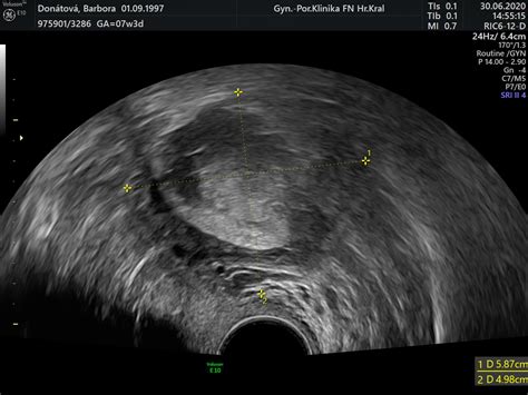Diagram porovnávajúci transvaginálny a transabdominálny ultrazvuk